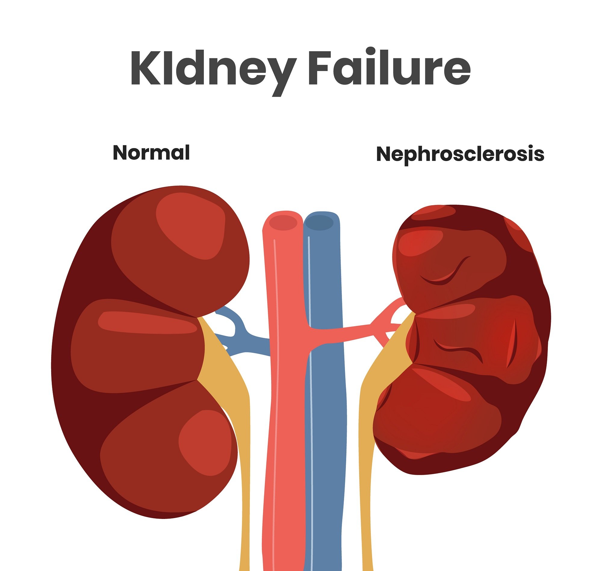 Vector illustration of the kidney failure. Normal kidney versus kidney affected with nephrosclerosis. Scalable illustration of the urine system with the vessels